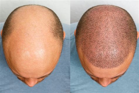 hair transplant albuquerque|THE BEST 10 Hair Loss Centers in ALBUQUERQUE, NM .